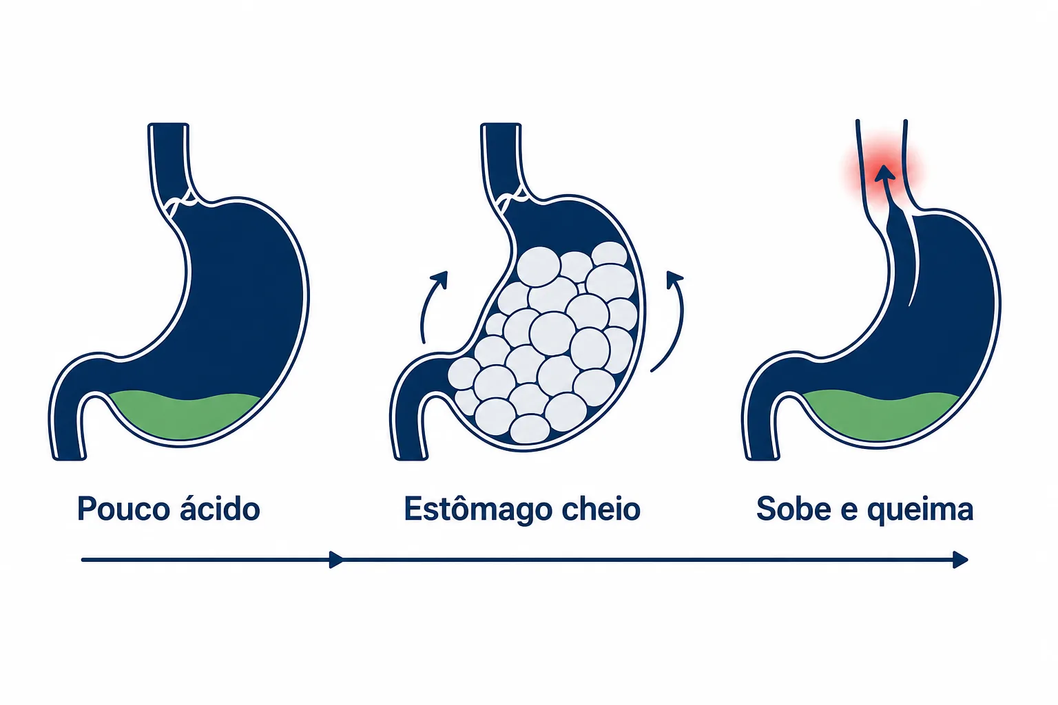 Infográfico explicando por que a hipocloridria causa azia, com o alimento parado no estômago, o esfíncter abrindo e o conteúdo subindo para o esôfago